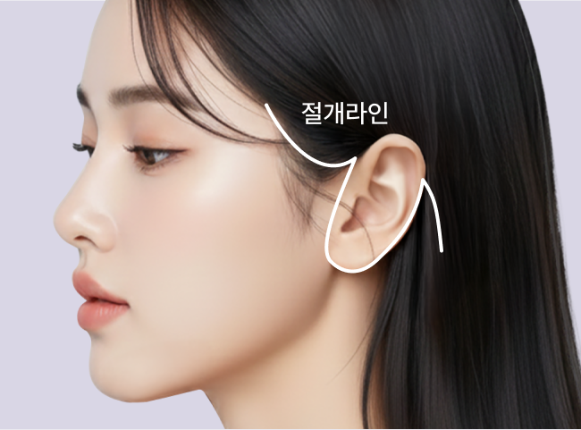 리팅 안면거상의 절개라인