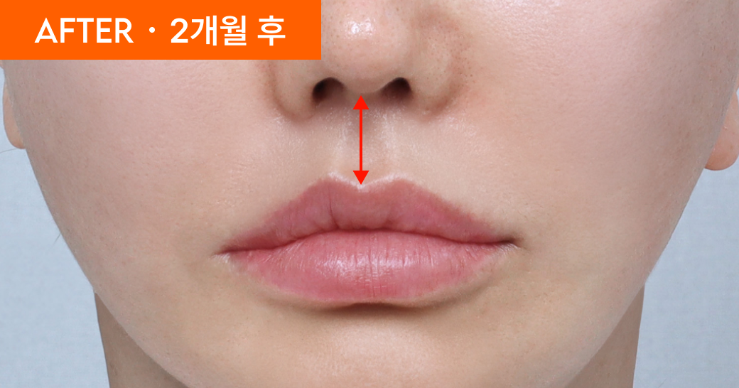 AFTER &middot; 2개월 후