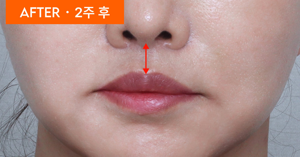 AFTER &middot; 2주 후