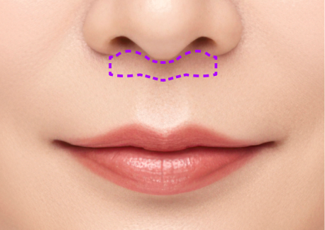 인중축소술 1단계