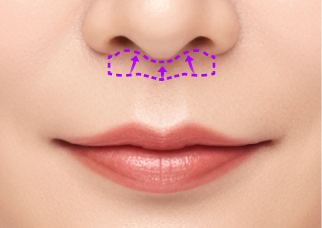 인중축소술 1단계