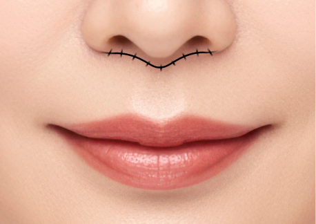 인중축소술 1단계