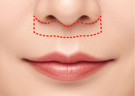 인중축소술 2단계 