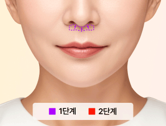 인중축소술이란?