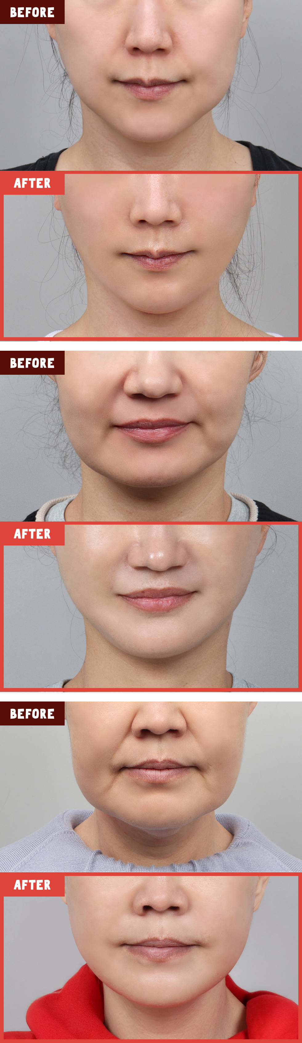 턱선이 각지고 전체적으로 둔탁한 얼굴형인 경우