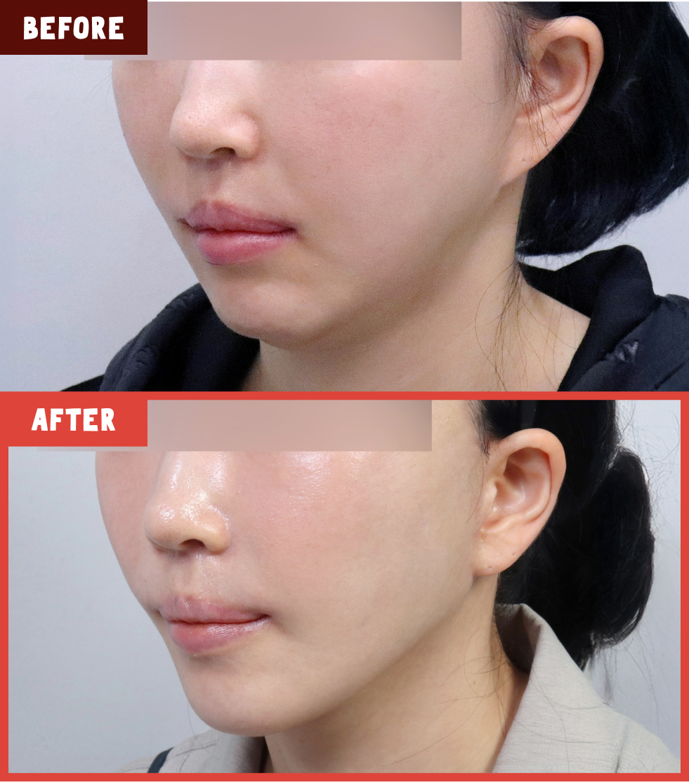 칼귀 교정이 필요한 경우