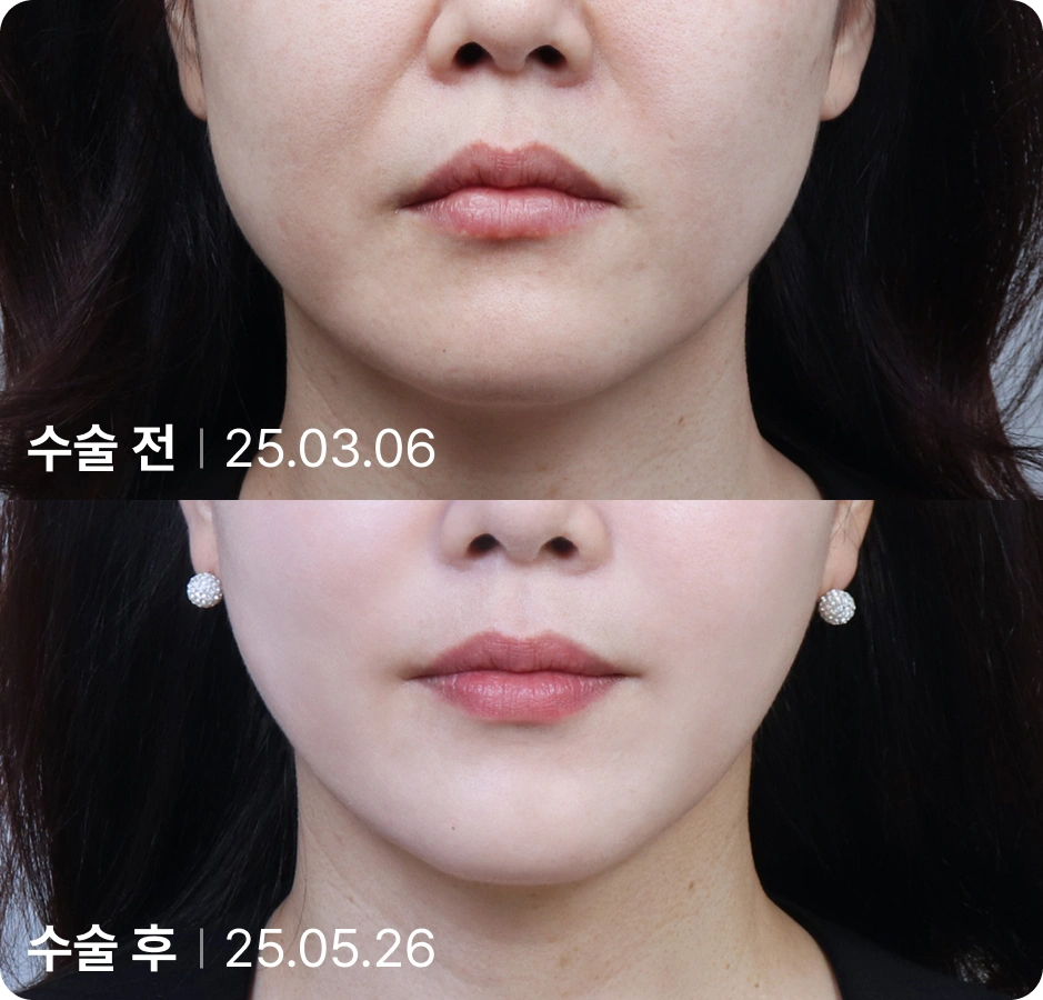 수술 전 | 수술 후