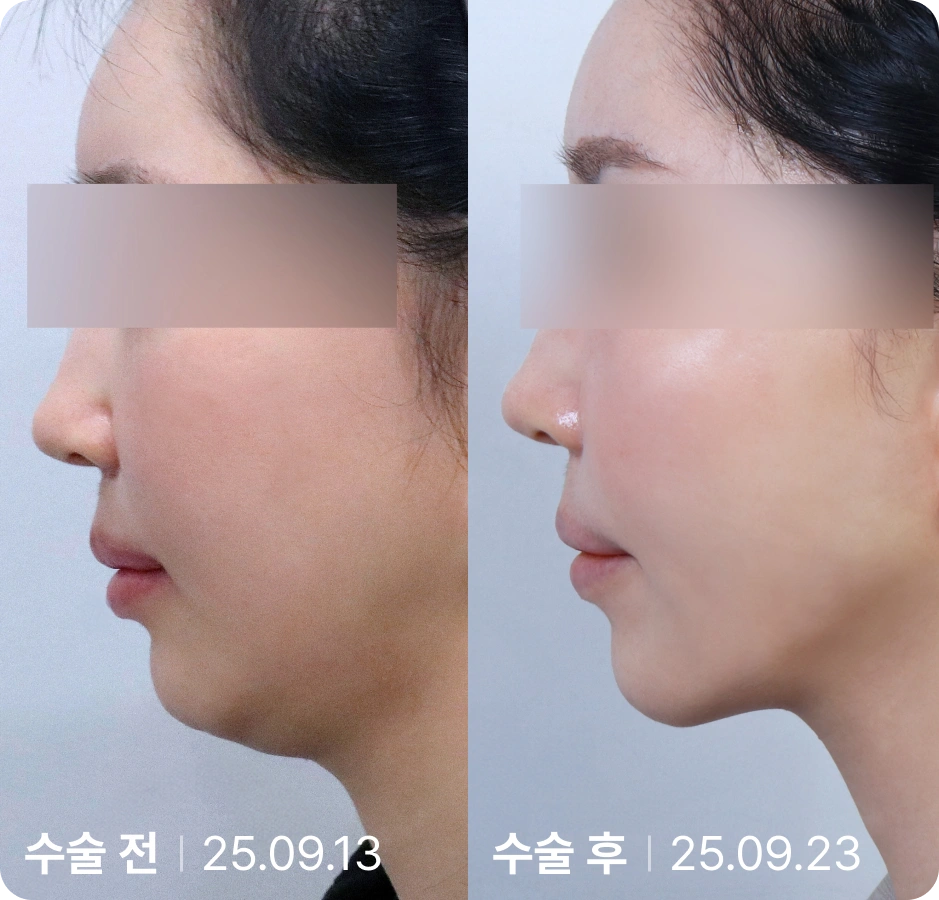 수술 전 | 수술 후
